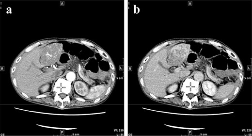 CT at initial admission points out a tumor with a maximum diameter of 8 cm in the lateral hepatic region and ascites around the liver. Dynamic CT shows blood vessel-like early staining inside the tumor, and the contrast effect gradually enhances. (a) Arterial phase, (b) equilibrium phase. CT, computed tomography.