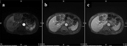 During Gd-EOB-DTPA-enhanced MRI at the time of initial hospitalization, the contrast effect of the tumor gradually increased from the peripheral part toward the hepatocyte phase from the arterial phase. (a) Arterial phase, (b) portal phase, (c) hepatocyte phase. Gd-EOB-DTPA, gadolinium ethoxybenzyl diethylenetriamine pentaacetic acid; MRI, magnetic resonance imaging.