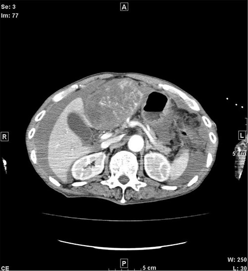 CT when the patient was transported in a state of shock shows increased bloody ascites but no apparent extravasation. CT, computed tomography.