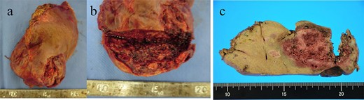 (a, b) A macroscopic image of the post-ruptured tumor (7 × 4 cm) in the left lateral segment. (c) After formalin fixation. The cut surface is white, the edges are brown and the boundaries are unclear.