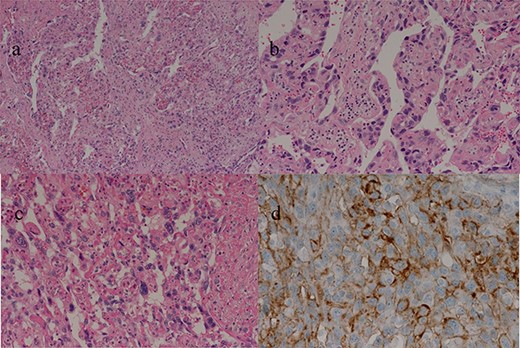 (a–c) Sections of the white and brown parts of the margin reveal viable tumors, highly atypical spindle-shaped cells, arranged like sinusoidal vessels and partly solid, with many mitotic figures. There is no capsule, and the tumor is shown infiltrating the surrounding liver parenchyma. (d) Immunostaining shows CD34 (partially positive), and the patient is diagnosed as having hepatic angiosarcoma.