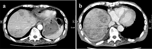 (a) CT on Day 21 after surgery. Multiple tumors are found in the liver. (b) CT re-examination performed 27 days after the operation shows multiple rapidly increasing liver masses. CT, computed tomography.