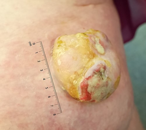 Large left lower limb ulcerating lesion at the time of presentation, to scale.