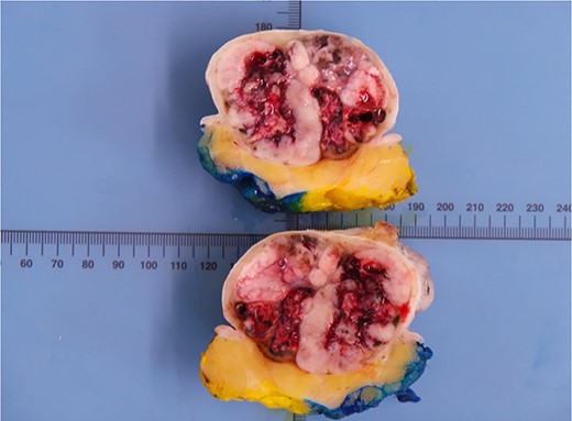 Macroscopic image of the lesion following bisection.