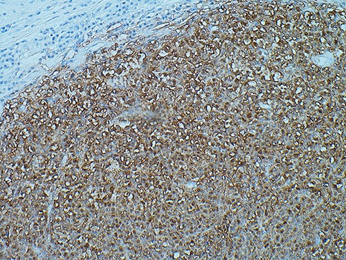 SOX10 immunohistochemistry showing nuclear stain staining confirming the diagnosis of malignant melanoma, magnification ×200.