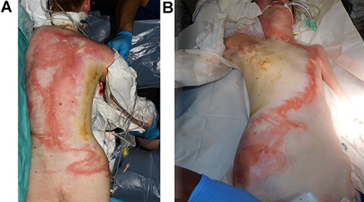 A view demonstrating the extent of the burn upon initial presentation to hospital: (A) back; (B) neck, torso and hip.