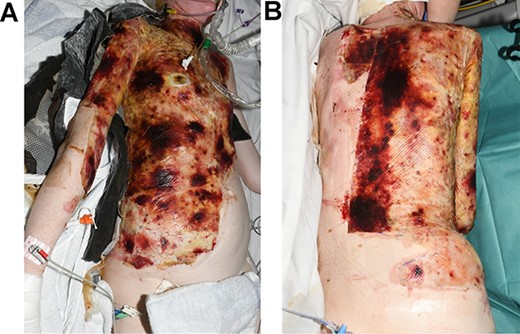 One week after the application of BTM: (A) torso, right flank and right arm; (B) back.