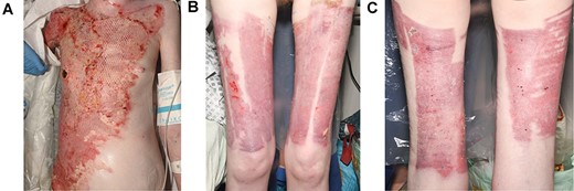 14 days after the application of split thickness skin graft: (A) good graft take to neck, chest and abdomen; (B) anterior view of healed donor sites; (C) posterior view of healed donor sites.