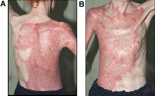 8 weeks post-application of split thickness skin graft: (A) posterior view; (B) anterior view.