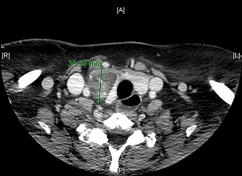 Axial CT scan image showing a right thyroid nodular lesion, discovered incidentally.