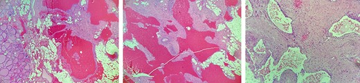 Histological images, showing ectatic vascular spaces filled with blood, lined by flat endothelial cells without atypia and also areas with variable fibrosis, all compatible with a cavernous hemangioma of thyroid origin.