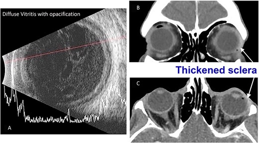 (A) B-scan USG of the patient’s left eye taken during their initial emergency department presentation demonstrating significant vitreous debris consistent with endophthalmitis. (B) Maxillofacial coronal postcontrast CT scan demonstrating left eye scleral thickening more prominent laterally (arrow) and globe asymmetry. (C) Axial postcontrast image of the orbits demonstrating left eye scleral thickening more prominent laterally (arrow) and globe asymmetry.