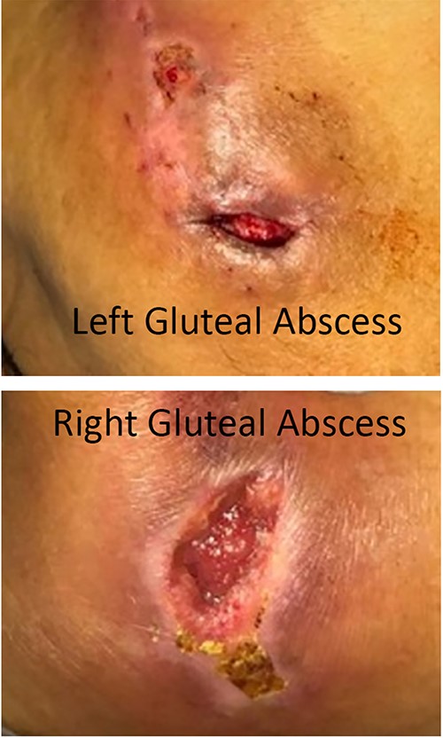 Digital photography of the patient’s untreated soft tissue infections taken during their initial emergency department presentation. (A) Image of the patient’s left gluteus demonstrating an open, draining abscess. (B) Image of the patient’s right gluteus demonstrating a second open, draining abscess.