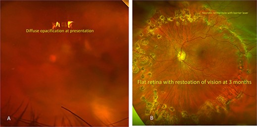 Color fundus photography of the patient’s left eye taken at different points during their disease course. (A) Fundus photography at the time of presentation showing diffuse vitritis with obscuration of details. (B) Fundus photography taken 3 months after hospital discharge demonstrating significant clearing of vitreous debris after PPV, RDR, vitreous debris removal and CEIOL. Barrier laser noted around necrotic retinal hole with flat retina.