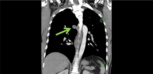 Coronal view of azygous vein aneurysm.