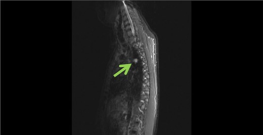 Sagittal view of azygous vein aneurysm.