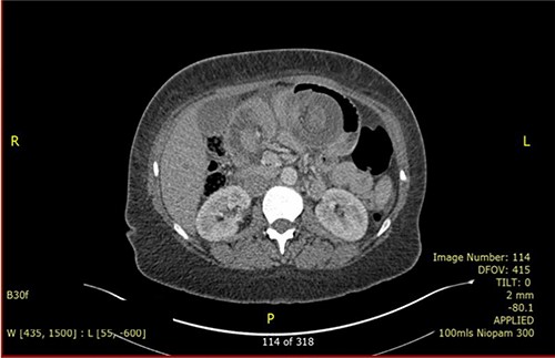 CECT showed the pathognomonic target sign.
