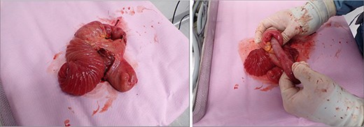 Intraoperative photo showing RI at jejuno-jejunal anastomosis.
