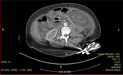 CECT showed the concentric ring sign.