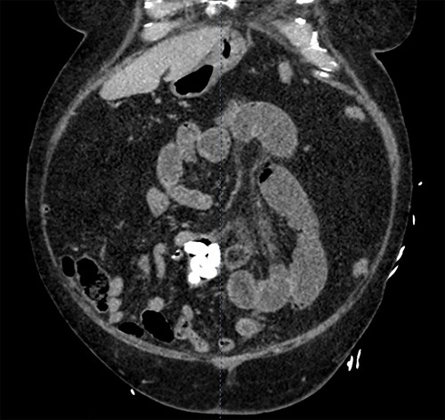 A CT scan of the abdomen and pelvis with contrast revealing a dilatation of the distal jejunum with air fluid levels and fecalization.