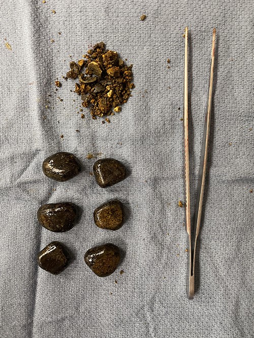 Seven large gallstones each approximately 2.0 cm in diameter were liberated.