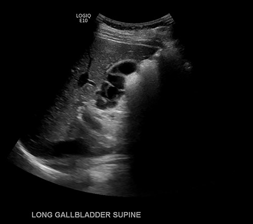 Ultrasound imaging of the gallbladder showing multiple septations resulting in a ‘sack of grapes’ appearance.