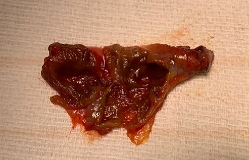 Gross specimen after cholecystectomy showing multiple internal septations and no stones.