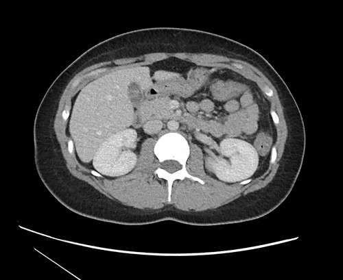 CT imaging at time of presentation to the ED showing multiple septations within the gallbladder.