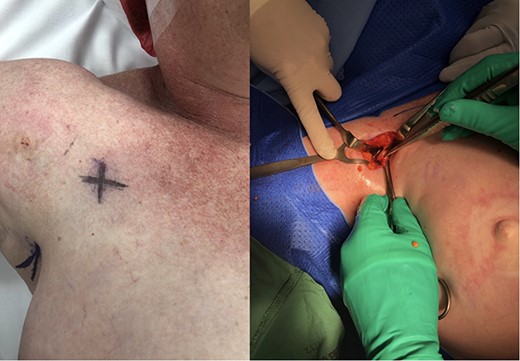 Pre-operative marking and intraoperative photograph.