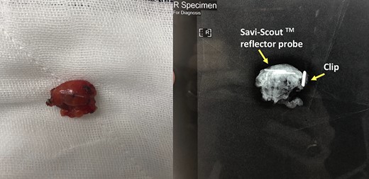 Biopsied lesion and specimen XR containing marking clips and Savi-Scout Reflector.