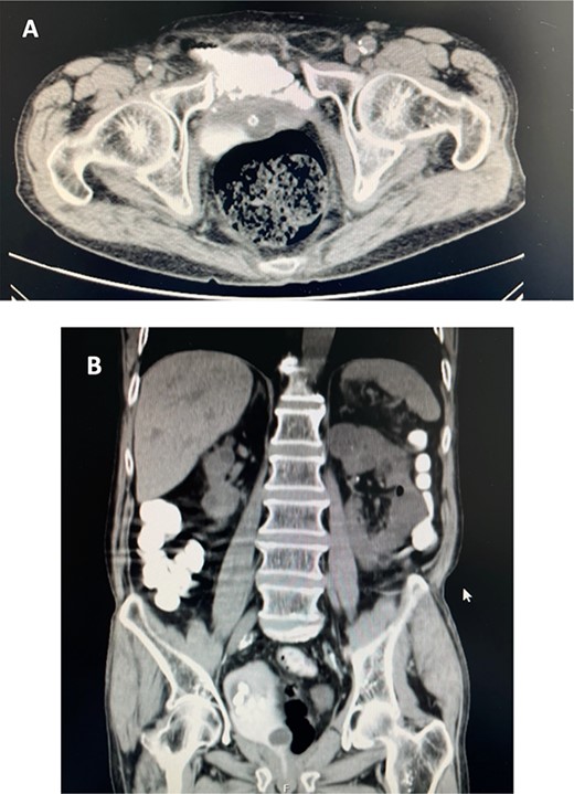 (A). CT scan with oral contrast (axial view) revealed passage of contrast from an ileal loop to neobladder. (B). CT scan with oral contrast (coronal view) showing multiple stones in neobladder.