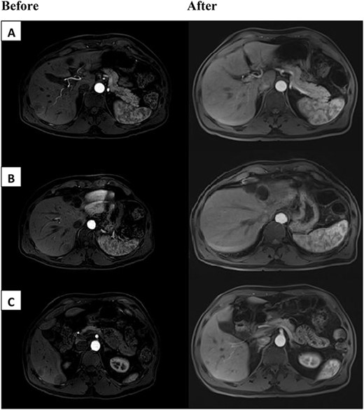 Above are representative images demonstrating severity of patient’s tumor burden, before (left) and after (right) dual anti-HER2 therapy. Patient had bilobar liver metastases ranging from 2.5 to 3 cm in segments 5, 7 and 8. Before images appear different than after due to institutional variation of MRI scanners.
