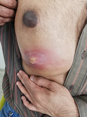 The chest wall abscess at time of presentation.