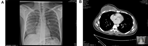 (A) Chest X-ray: linear nodular density right upper lobe. (B) CT Thorax at presentation showing the right-sided anterior chest wall, septating mass highly suspicious of a TB infection.