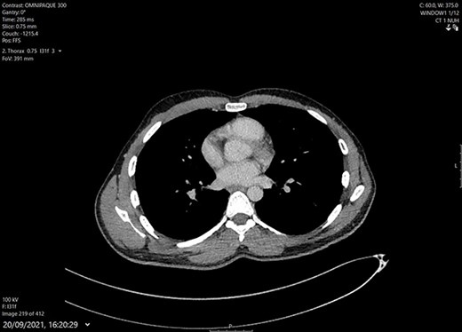 CT Thorax after completing 9 months of medical treatment and surgical debridement of abscess. Shows complete resolution of chest wall mass and intact bony structure underneath.