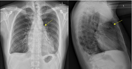 Postero-anterior erect and lateral chest radiograph. Lucency over the left heart border and anterior middle mediastinum consistent with a pneumopericardium.