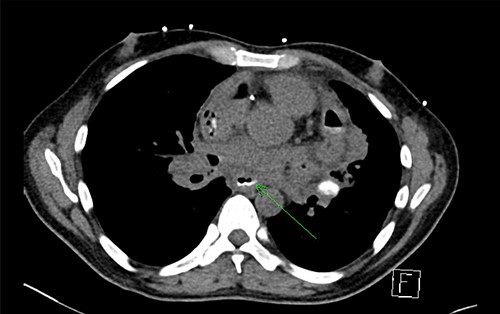 CT with water-soluble oral contrast. Trace amount of contrast that extends to the left lateral aspect of the oesophagus representing a thin tract.