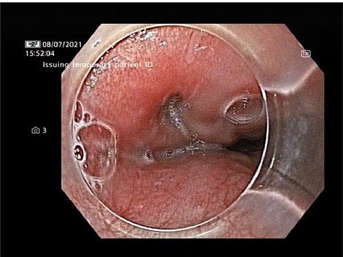 Upper gastrointestinal endoscopy demonstrated three mucosal defects 31 cm from the incisors.