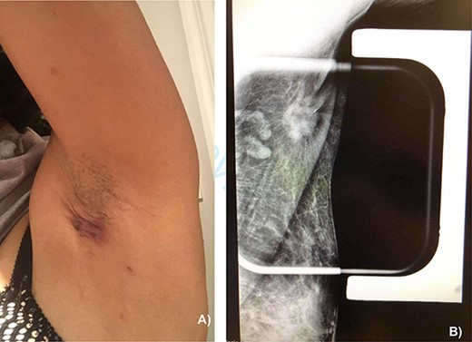 (A) Appearance of the left axillary lesion at presentation. (B) Magnified view on mammogram of the left axilla showing an irregular mass with extension to the skin in the context of an ectopic mammary gland.