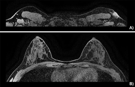 Breast MRI depicting (A) the known mass in a superficial axillary position with direct invasion of the overlying skin and dermal thickening, measured at 1.8 × 1.3 cm wide by 1.9 cm in height. The left axillary nodes appear more numerous and slightly enlarged but share no malignant features. (B) The left and right breast showing no sign of neoplasia.