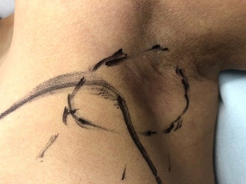 Pre-operative appearance of the left axillary lesion (circled in black) following neoadjuvant therapy.