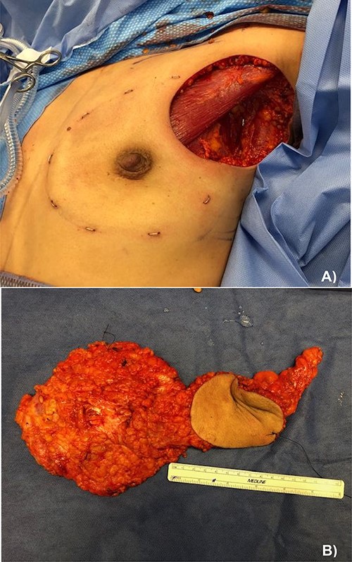 (A) Left nipple sparing mastectomy with axillary lymph node dissection and en-block skin excision and (B) pathological specimen containing from left to right: the total mastectomy, excised skin and axillary lymph node dissection.