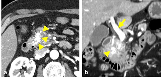 Contrast-enhanced CT images. (a) Vessels in the pancreatic head were strongly enhanced during the arterial phase (arrowheads). (b) Both the vessels in the pancreas head (arrowhead) and the portal vein (arrow) were enhanced at the arterial phase.