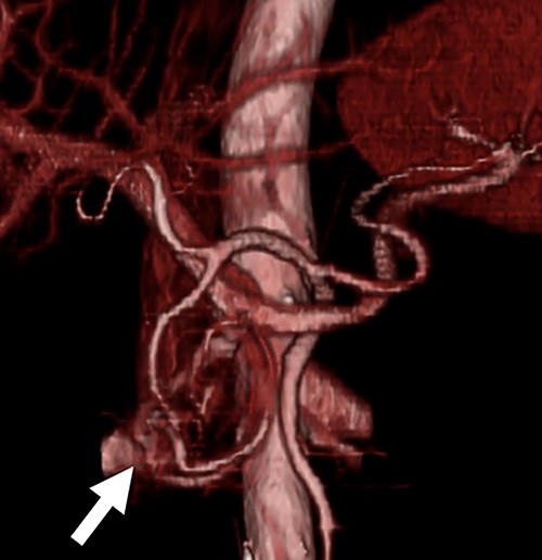 Three-dimensional CT image. The three-dimensional CT imaging showed the communication between arteries and veins in the pancreatic head (arrow).