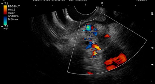 Endoscopic ultrasonography image. Endoscopic ultrasonography showed tortuous vessels and low echoic lesions in the pancreas head, and no findings suspicious of malignancy.