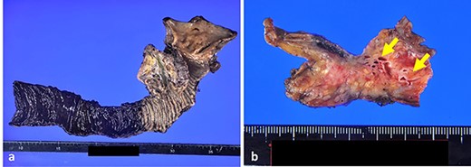Gross appearance of specimens. (a) Gross appearance of pancreaticoduodenectomy specimen. (b) Slice of the pancreatic head showed dilated meandering blood vessels (arrows).