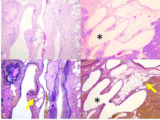 Histopathological findings. (a, b) Dilated and tortuous veins and arteries. The transition from an artery to a vein was detected (b, asterisk). (c, d) Development of elastic fibers with thickening wall of arteries (c, colorless arrow) and dilated veins with steatosis of the pancreas parenchyma (c and d, colored arrow). (a, b) Hematoxylin–eosin staining; (c, d) Elastica van Gieson staining).