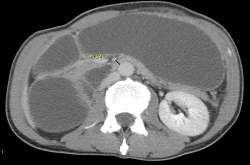 The abrupt narrowing of the duodenum measuring 5 mm.