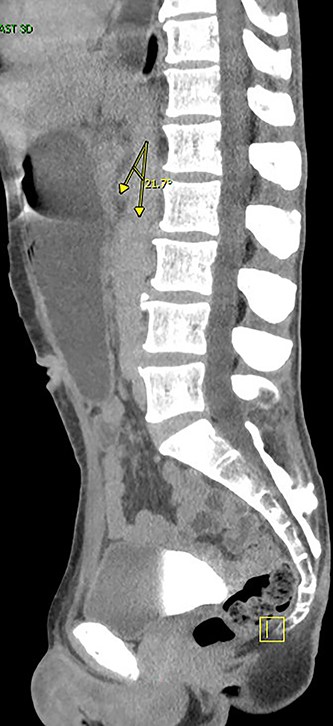 Angle between superior mesenteric and aorta artery measuring 21. deg.