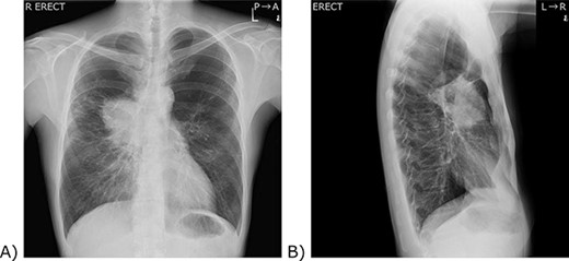 Chest X-ray. (A) A frontal view. (B) A lateral view. (A) A 9 cm tumour was located in the right hilum of the patient. The right pulmonary artery and the lower part of the superior vena cava are silhouetted out, and the boundary cannot be seen. (B) The tumour was located anterior to the hilum of the lung.